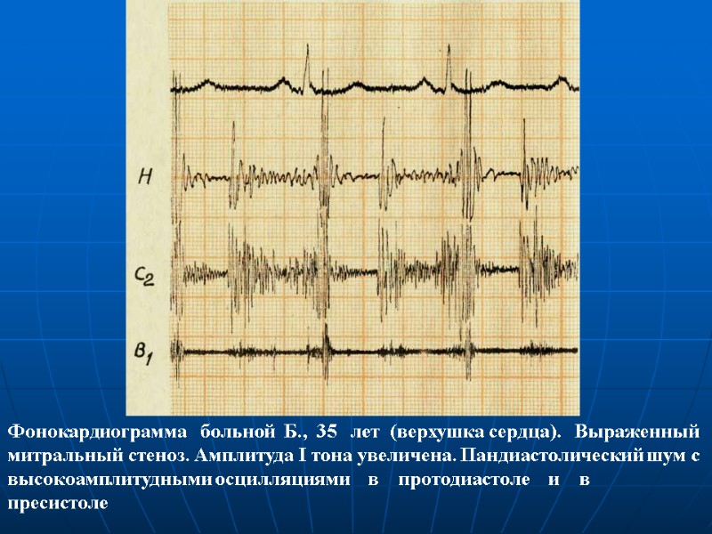 Фонокардиограмма больной Б., 35 лет (верхушка сердца). Фонокардиограмма больной Б., 35 лет (верхушка сердца).